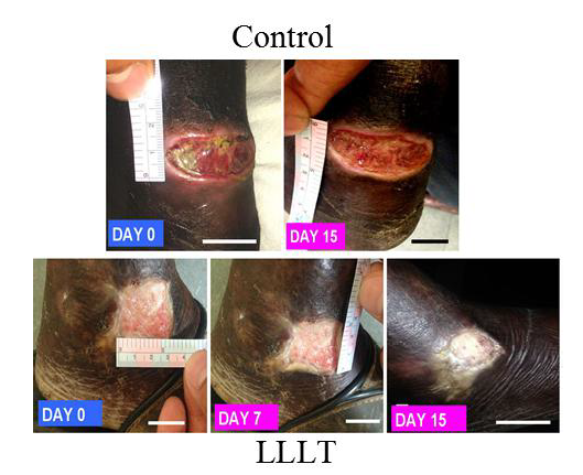 Effect of LLLT (660 ± 20 nm, ~3 J/cm<sup>2</sup>) on DFUs. Wound contraction with respect to day 0, in control and LLLT group