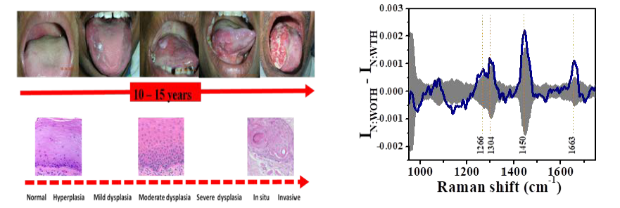 Progression of oral cavity cancer with tobacco consumption habits and the mean difference spectra showing statistical differences between oral tissue Raman spectra of healthy volunteers without any tobacco consumption habit (N:WOTH) and with tobacco consumption habit (N:WTH). Ref: Journal of Analytical Oncology: 5(3), 110-123, 2016.