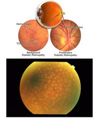 A portion of treated retina with this system